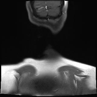 File:Bilateral carotid body tumors and right jugular paraganglioma (Radiopaedia 20024-20060 None 24).jpg
