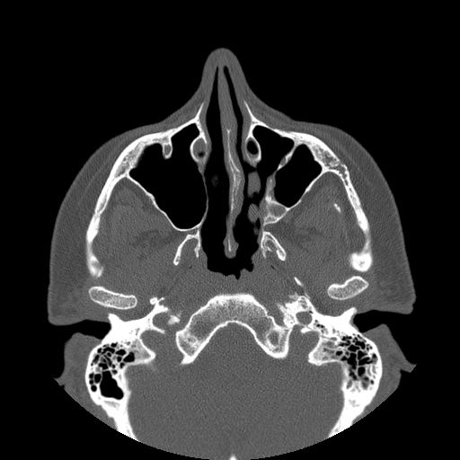 File:Bilateral ectopic infraorbital nerves (Radiopaedia 49006-54084 Axial 1).jpg