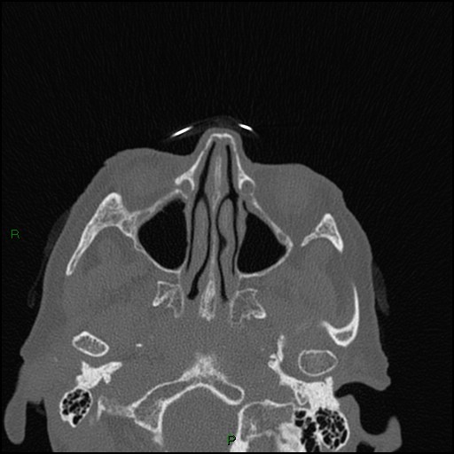 File:Bilateral frontal mucoceles (Radiopaedia 82352-96454 Axial bone window 177).jpg