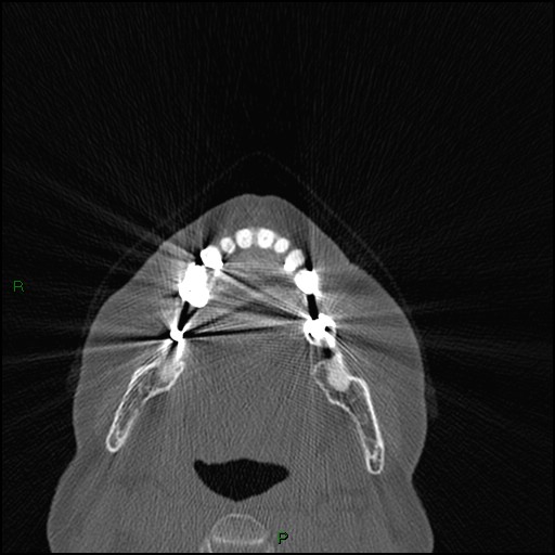 Bilateral frontal mucoceles (Radiopaedia 82352-96454 Axial bone window 278).jpg