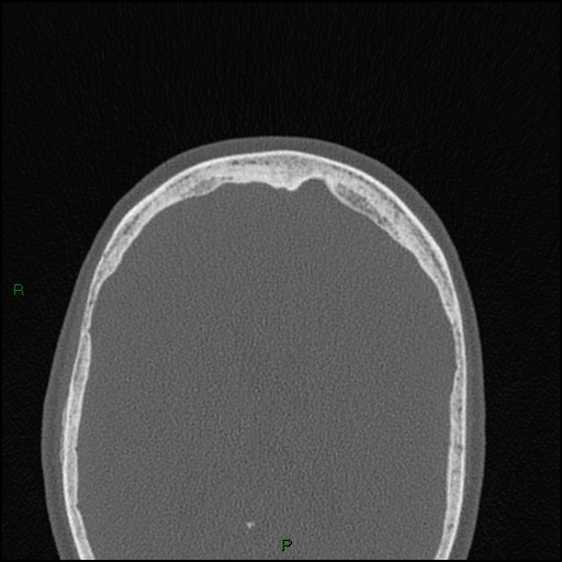 Bilateral frontal mucoceles (Radiopaedia 82352-96454 Axial bone window 47).jpg