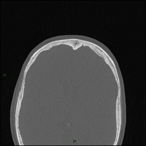 Bilateral frontal mucoceles (Radiopaedia 82352-96454 Axial bone window 60).jpg