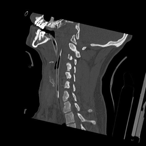 Bilateral locked facets (Radiopaedia 33850-35023 Sagittal bone window 23).png
