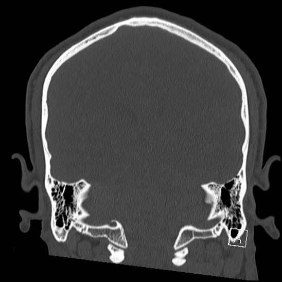 Bilateral occipital condyle fracture (type 2) (Radiopaedia 87675-104089 Coronal bone window 89).jpg
