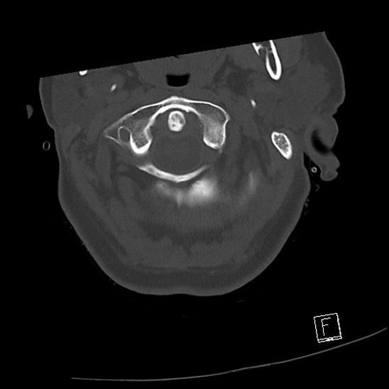 Bilateral occipital condyle fractures (type 3) (Radiopaedia 87672-104086 Axial bone window 14).jpg