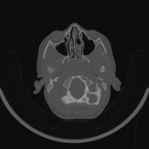 Bilateral otosclerosis (Radiopaedia 57237-64157 C 10).jpg