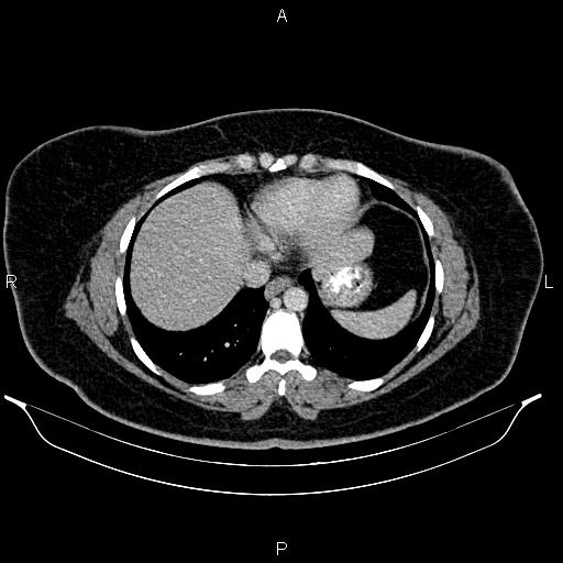 File:Bilateral ovarian dermoid cysts (Radiopaedia 85785-101603 A 13).jpg