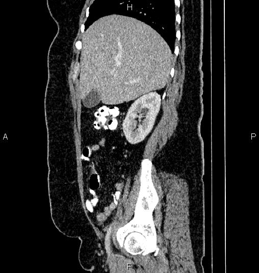 Bilateral ovarian dermoid cysts (Radiopaedia 85785-101603 D 21).jpg