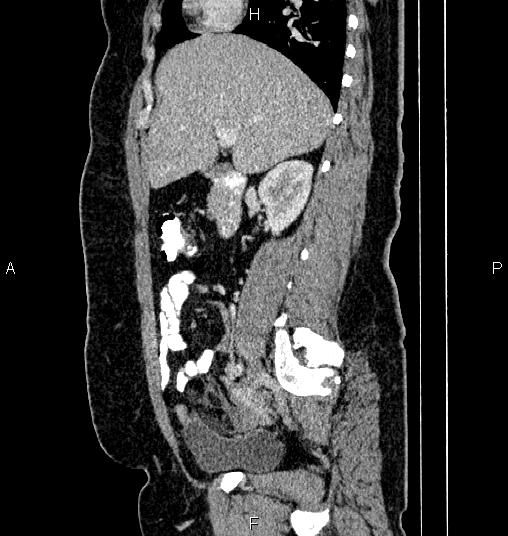 Bilateral ovarian dermoid cysts (Radiopaedia 85785-101603 D 31).jpg