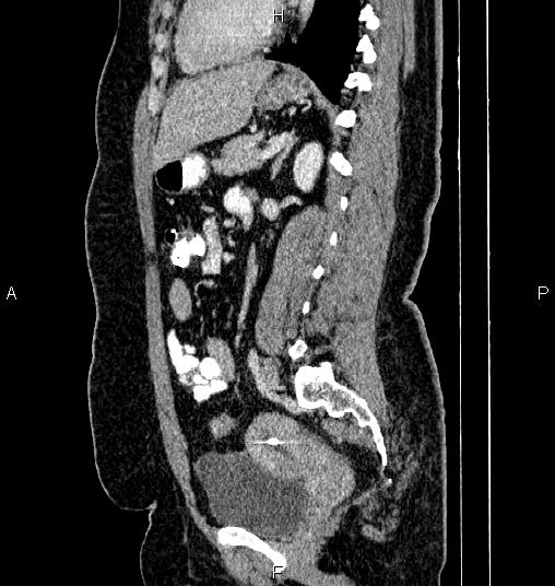 Bilateral ovarian dermoid cysts (Radiopaedia 85785-101603 D 56).jpg