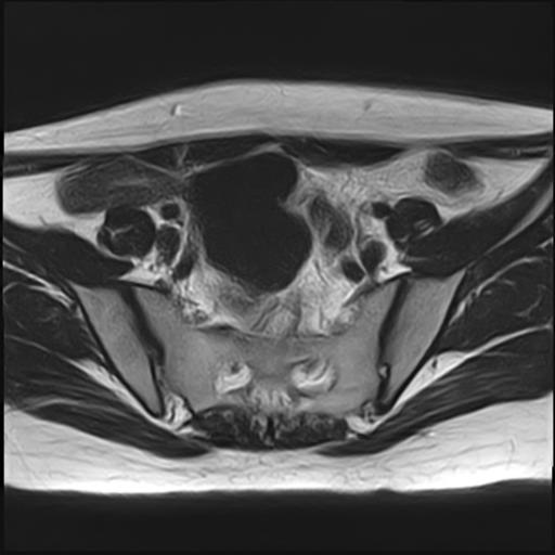 File:Bilateral ovarian endometriomas (Radiopaedia 87085-103347 Axial T2 5).jpg