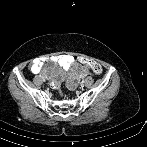 Bilateral ovarian serous cystadenocarcinoma (Radiopaedia 86062-101989 B 81).jpg