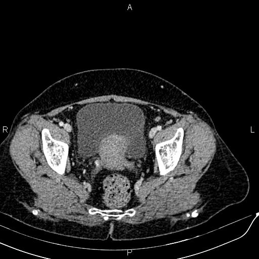 Bilateral ovarian serous cystadenocarcinoma (Radiopaedia 86062-101989 B 90).jpg
