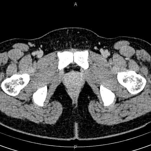 Bilateral ovarian teratoma (Radiopaedia 83131-97503 B 81).jpg