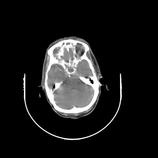 Bilateral parotid gland lymphoma (Radiopaedia 21038-20969 A 2).jpg