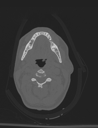 File:Bilateral perched facet joint (Radiopaedia 63149-71669 Axial bone window 15).jpg