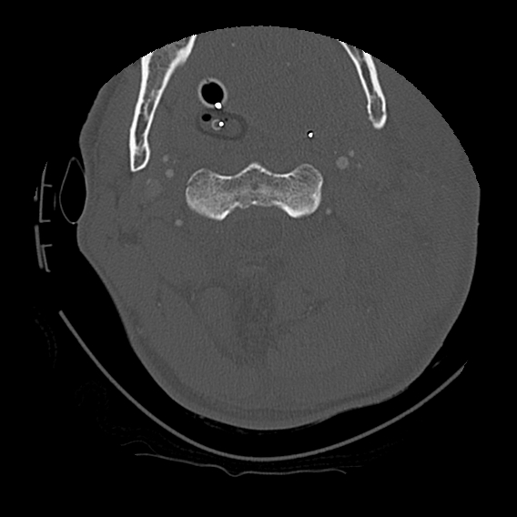 File:Bilateral perched facets with cord injury (Radiopaedia 45587-49713 Axial bone window 35).jpg