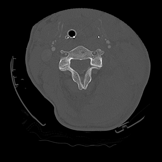 Bilateral perched facets with cord injury (Radiopaedia 45587-49713 Axial bone window 46).jpg