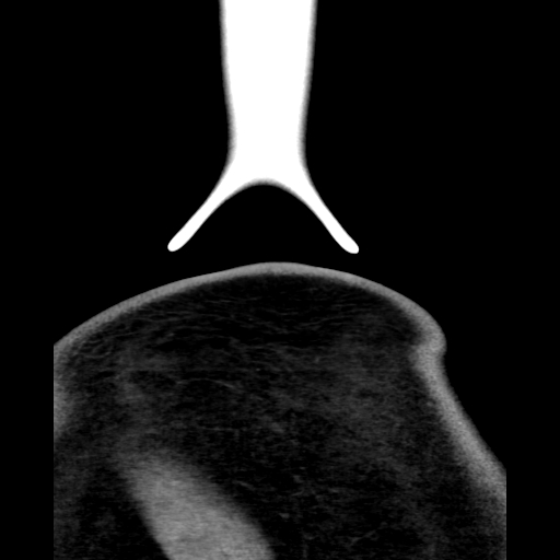Bilateral peritonsillar abscess (Radiopaedia 85065-100610 Coronal 81).jpg