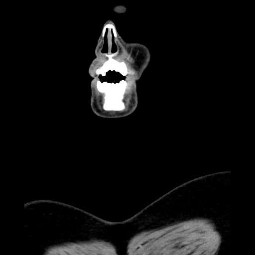 Bilateral peritonsillar abscess (Radiopaedia 85065-100610 Coronal 9).jpg