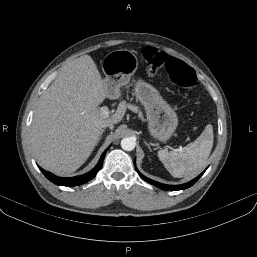 File:Bilateral pulmonary AVM (Radiopaedia 83134-97505 A 73).jpg
