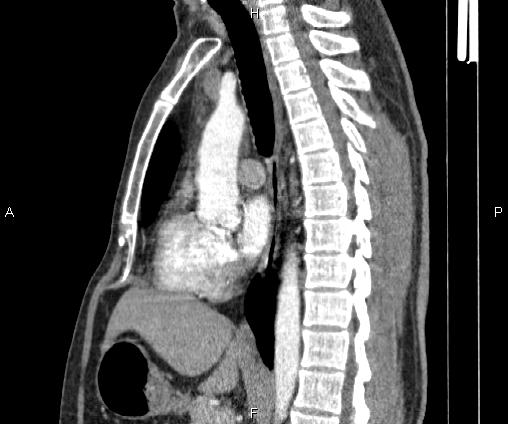 Bilateral pulmonary AVM (Radiopaedia 83134-97505 D 61).jpg