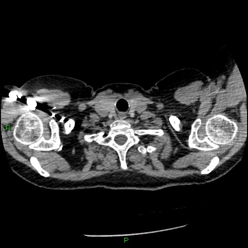 File:Bilateral pulmonary emboli (Radiopaedia 32700-33669 Axial C+ CTPA 4).jpg