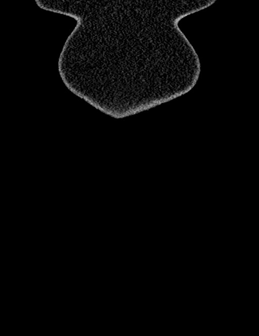 Bilateral staghorn calculi (Radiopaedia 59475-66842 Coronal non-contrast 23).jpg