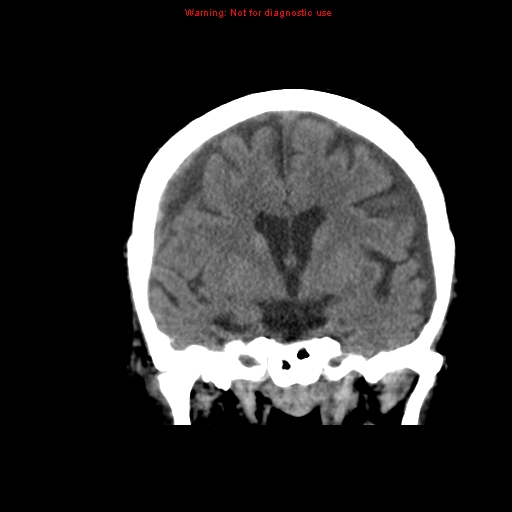 File:Bilateral subdural hemorrhage (Radiopaedia 8819-9620 Coronal non-contrast 4).jpg