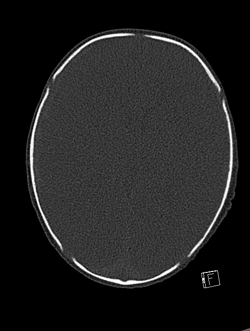 Bilateral subdural hemorrhage and parietal skull fracture (Radiopaedia 26058-26192 Axial bone window 57).png