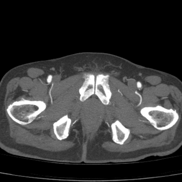 Bilateral superficial femoral arterial occlusion (Radiopaedia 25682-25857 A 28).jpg