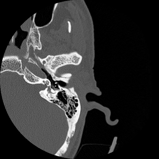File:Bilateral temporal bone fractures (Radiopaedia 29482-29970 D 73).jpg