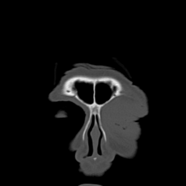 Biparietal osteodystrophy (Radiopaedia 46109-50463 Coronal bone window 13).jpg