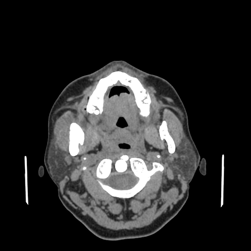 Bisphosphonate-related osteonecrosis of the jaw (Radiopaedia 71324-81642 non-contrast 102).jpg