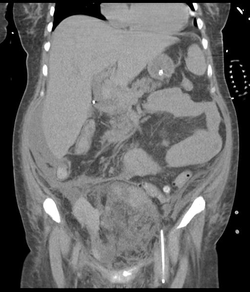 Bladder rupture post renal biopsy (Radiopaedia 30863-31572 Coronal non-contrast 26).jpg