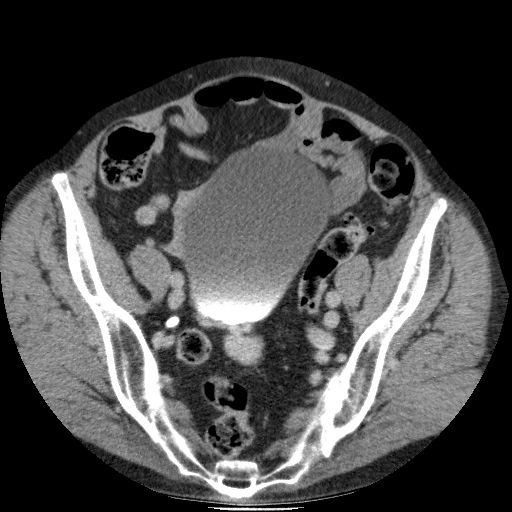 Bladder tumor detected on trauma CT (Radiopaedia 51809-57609 C 109).jpg