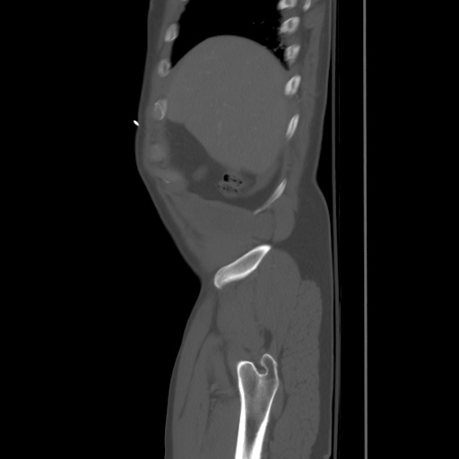 Blunt abdominal trauma with solid organ and musculoskelatal injury with active extravasation (Radiopaedia 68364-77895 Sagittal bone window 5).jpg