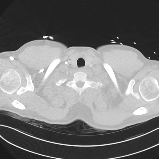 File:Boerhaave syndrome (Radiopaedia 39382-41660 Axial lung window 2).png