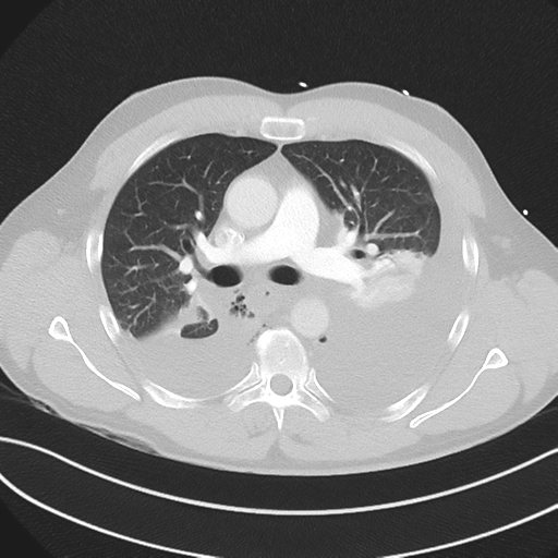 Boerhaave syndrome (Radiopaedia 39382-41660 Axial lung window 23).png