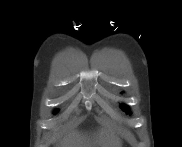 Boerhaave syndrome (Radiopaedia 39382-41660 C 12).png