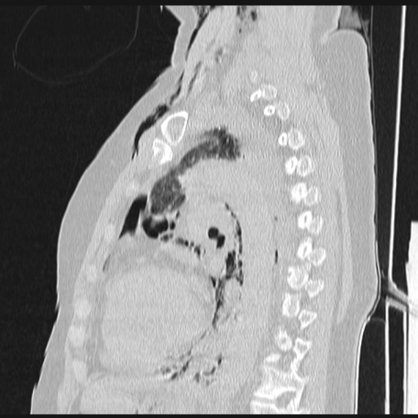 Boerhaave syndrome (Radiopaedia 45644-49799 Sagittal lung window 51).jpg