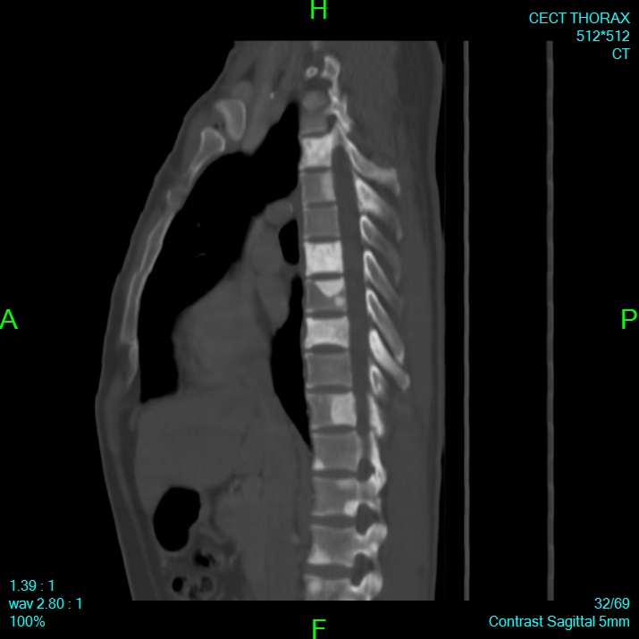 Bone metastases from lung carcinoma (Radiopaedia 54703-60937 Sagittal bone window 32).jpg