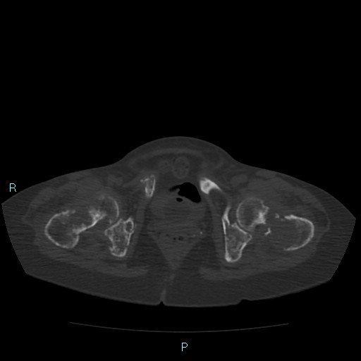 Bone metastases from untreated breast cancer (Radiopaedia 42973-46219 Axial bone window 191).jpg