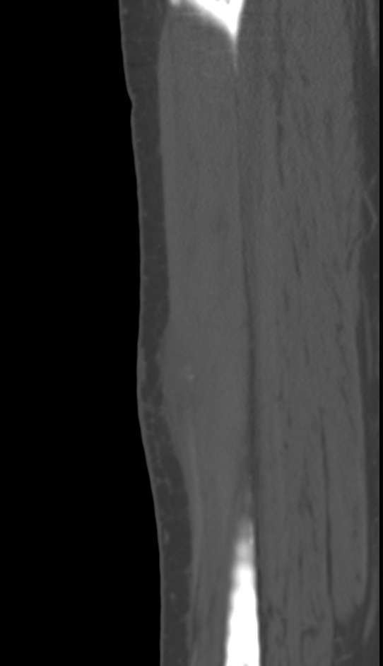 Bone metastasis - tibia (Radiopaedia 57665-64609 Sagittal bone window 120).jpg