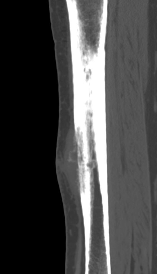 Bone metastasis - tibia (Radiopaedia 57665-64609 Sagittal bone window 94).jpg