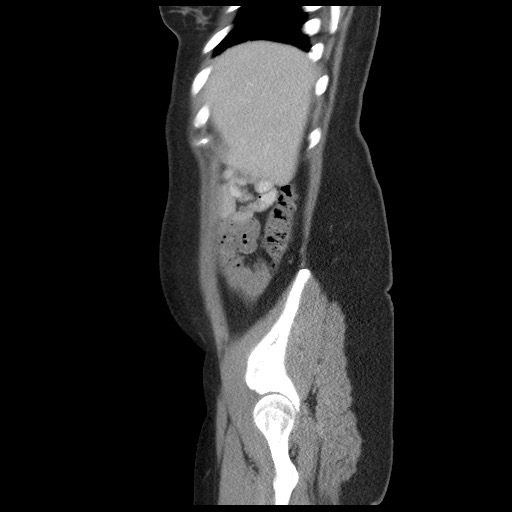 Borderline mucinous tumor (ovary) (Radiopaedia 78228-90808 B 15).jpg