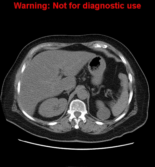 File:Bosniak renal cyst - type II (Radiopaedia 23404-23468 Axial non-contrast 3).jpg