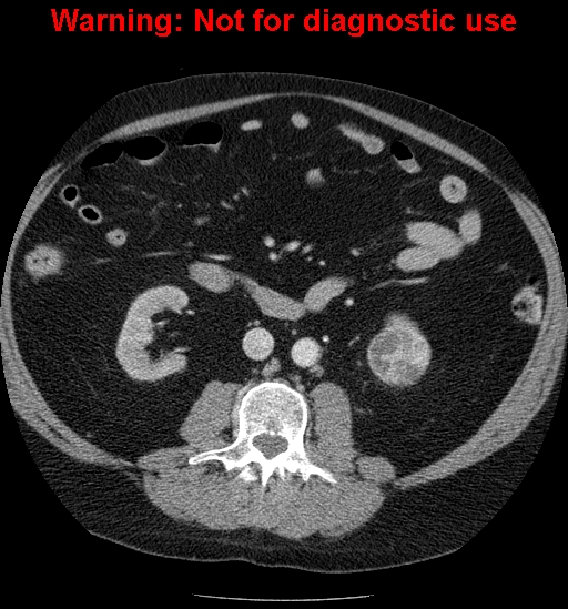 File:Bosniak renal cyst - type IV (Radiopaedia 23402-23466 D 36).jpg