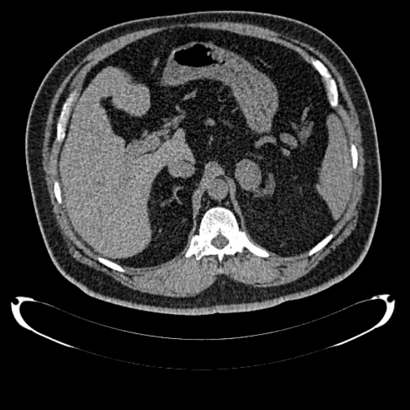File:Bosniak renal cyst - type IV (Radiopaedia 24244-24518 Axial non-contrast 119).jpg