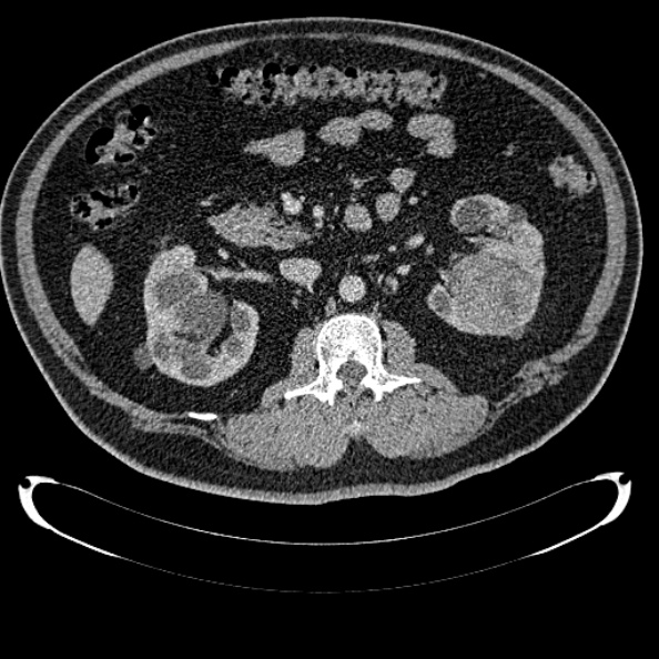 File:Bosniak renal cyst - type IV (Radiopaedia 24244-24518 C 152).jpg